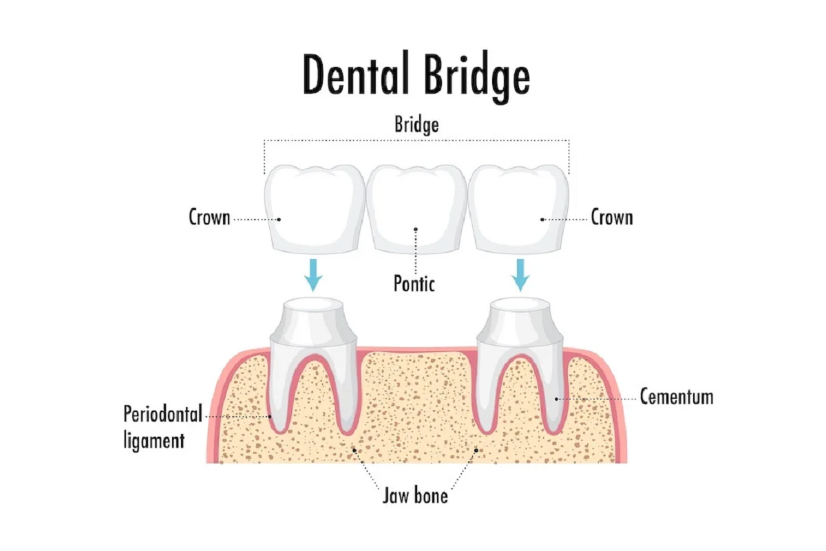 What is a Dental Bridge? 1 Dental bridge