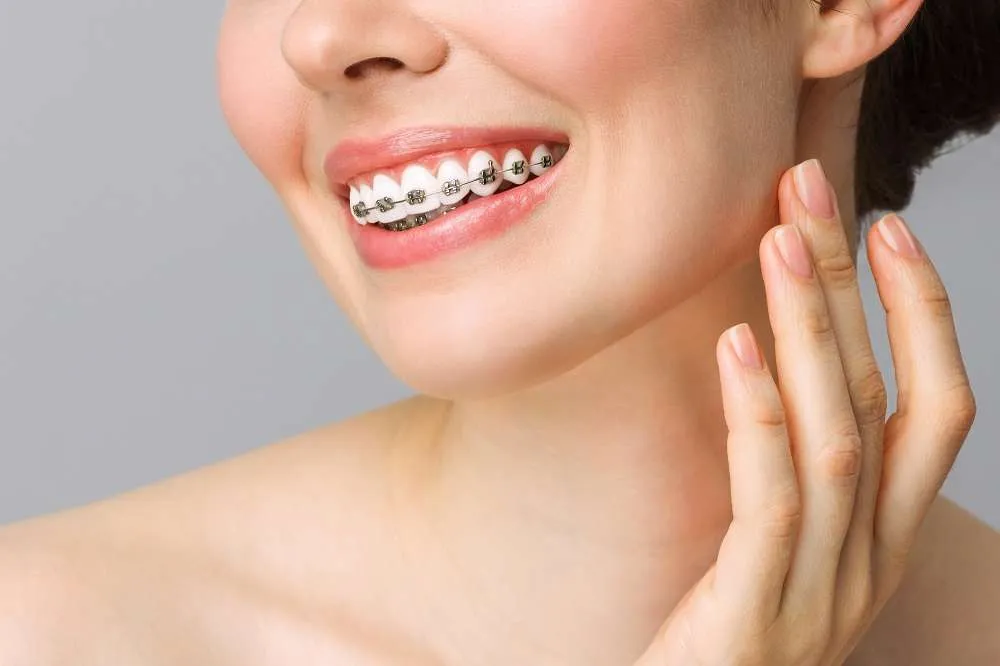 Guide to Braces … 1 Brace Blog 6 June 2023